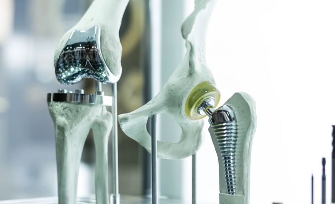 Bei Einsatz von Knie- oder Hüftprothesen werden beschädigte Gelenke durch künstliche Gelenke ersetzt. Prothese