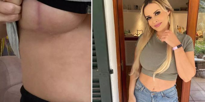 Schnipp-schnapp - Hier zeigt Daniela Katzenberger ihre Busen-OP-Narbe
