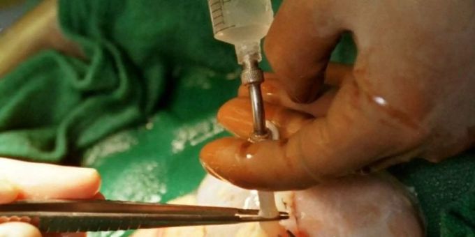Die Transplantation ist oft die letzte Rettung bei Leberzirrhose. Grazer Forscher haben nun eine Diagnose-Methode gefunden, die aufgrund eines einzigen Blutwerts sagt, ob Patient und Patientin schon in der Endphase der Erkrankung stecken. (Archivbild) Die Transplantation ist oft die letzte Rettung bei Leberzirrhose. Grazer Forscher haben nun eine Diagnose-Methode gefunden, die aufgrund eines einzigen Blutwerts sagt, ob Patient und Patientin schon in der Endphase der Erkrankung stecken. (Archivbild)