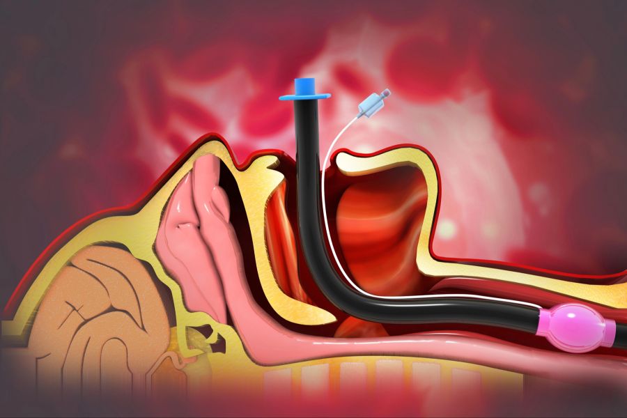 Intubation, Illustration