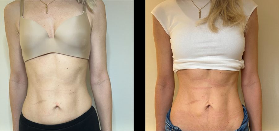 Die folgenden Vorher- und Nachherbilder veranschaulichen deutlich die Wirksamkeit der Carboxy-Behandlung.