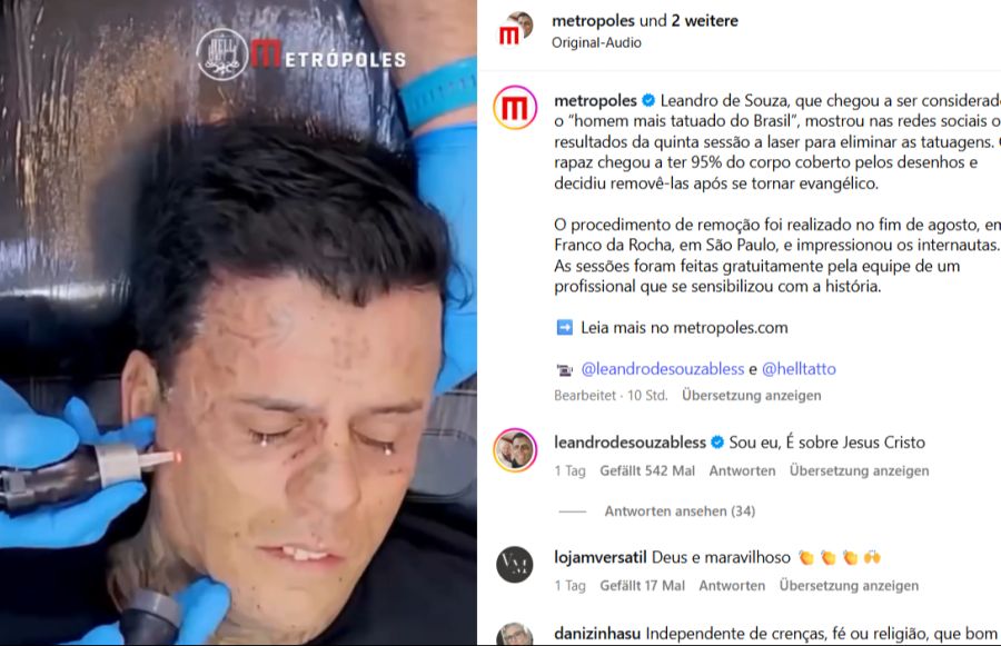 Laserbehandlungen
