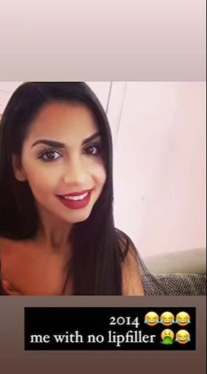 So sahen Mia Madissons Lippen vor den Lipfillern aus. Mia Madisson