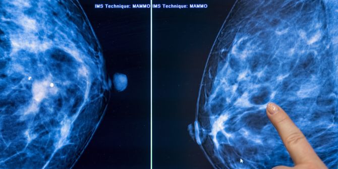 Mammografie Brustkrebs