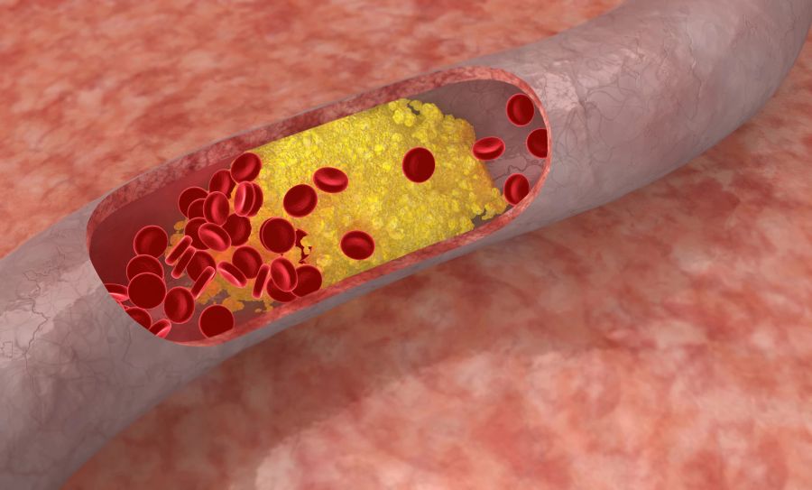 Cholesterin-Plaque in der Arterie.