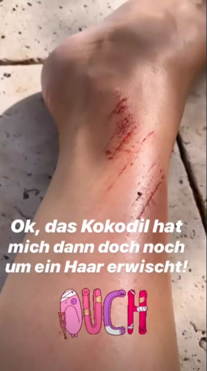 SRF Moderatorin Nicole Berchtold zeigt ihr aufgekratztes Bein. SRF