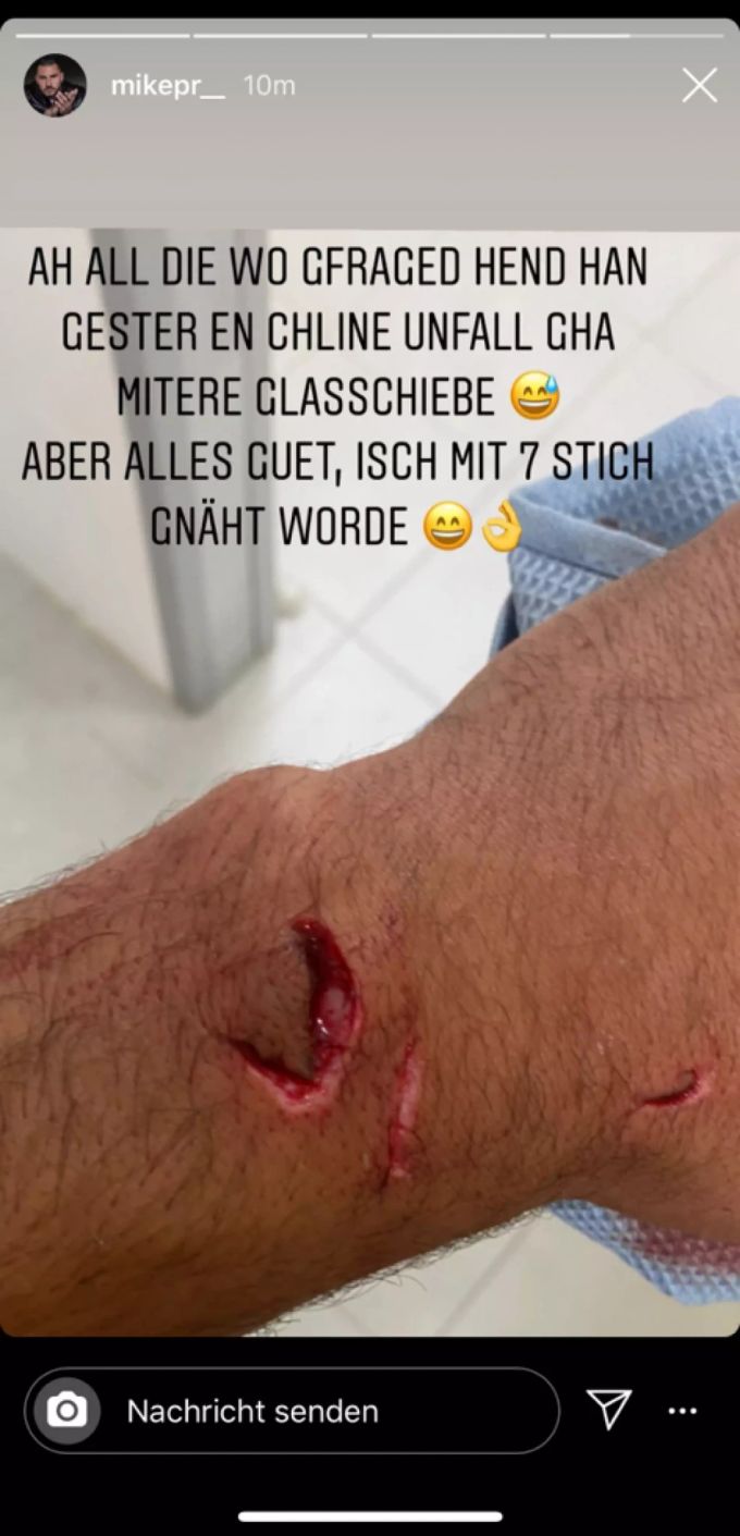 Mit sieben Stichen wurde die Wunde von Bachelorette 2020 Gewinner Mike genäht. Bachelorette 2020