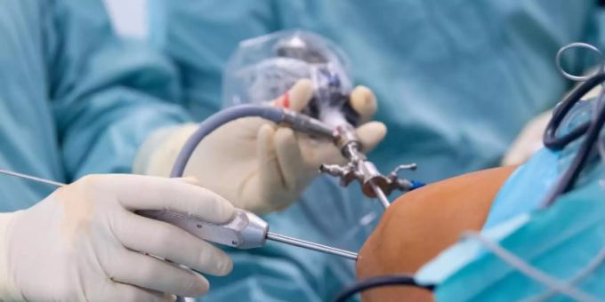 Ein Arzt operiert einen Patienten am Knie. Gutachter der Krankenkassen stellten im vergangenen Jahr über 4000 Behandlungsfehler fest, davon 2826, die gesundheitliche Schäden verursachten. Foto: Sven Hoppe/dpa/Archiv Ein Arzt operiert einen Patienten am Knie. Gutachter der Krankenkassen stellten im vergangenen Jahr über 4000 Behandlungsfehler fest, davon 2826, die gesundheitliche Schäden verursachten. Foto: Sven Hoppe/dpa/Archiv