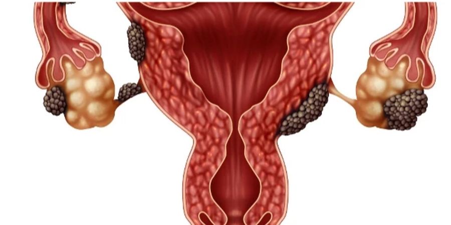 Endometriose