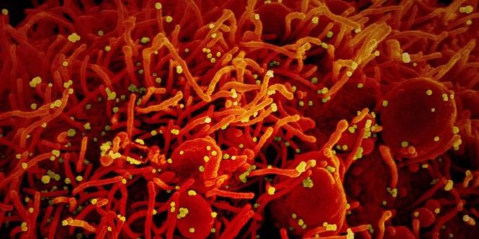Die Abbildung einer Zelle (rot), die mit dem Coronavirus (SARS-CoV-2, gelb) infiziert ist. Coronavirus