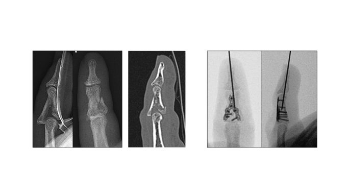 Röntgen- und CT-Aufnahme eines Fingers. KSA