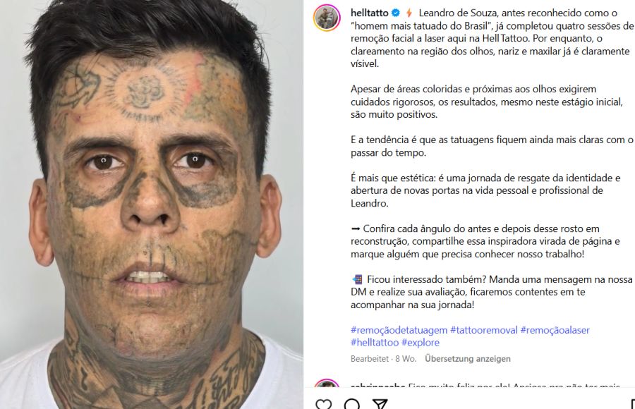 Mit jeder Laserbehandlung verblasst die Tinte ein Stück mehr.