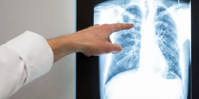 Tuberkulose - Fallzahlen in Deutschland leicht gestiegen