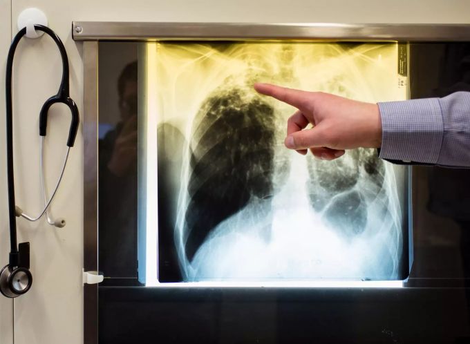 Ein Arzt zeigt einen Tuberkulose-Fall auf anhand eines Röntgenbildes. tuberkulose