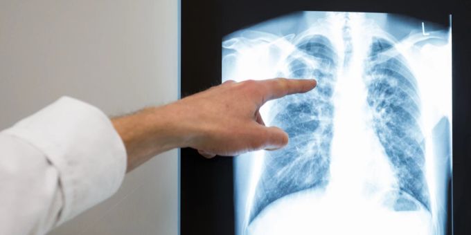 Roche Holding - Rückschlag in der Krebsforschung