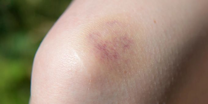Treten blaue Flecken bei kleinen Kindern gehäuft auf, kann das auf Hämophilie A hindeuten. Bluterguss Haut Gelenk hell