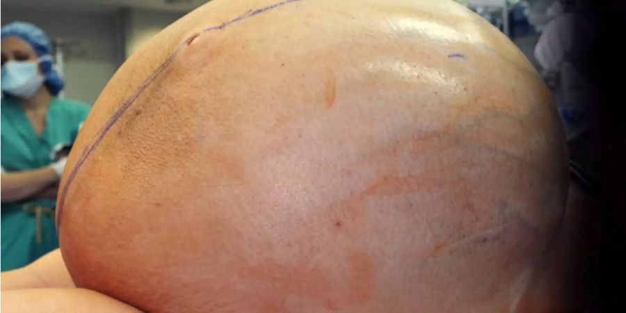 Während fünf Stunden versuchten 25 Ärzte den 60 Kilogramm schweren Tumor zu entfernen.