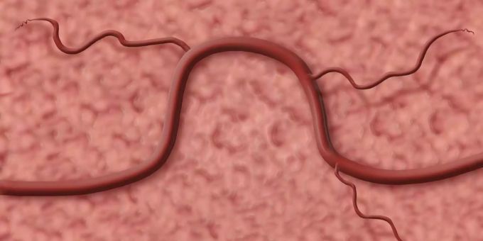 Wird ihre Zellmembran beschädigt, werden auch die Tumorzellen selber zerstört. Der Tumor kann vollumfänglich entfernt werden. Wird ihre Zellmembran beschädigt, werden auch die Tumorzellen selber zerstört. Der Tumor kann vollumfänglich entfernt werden.
