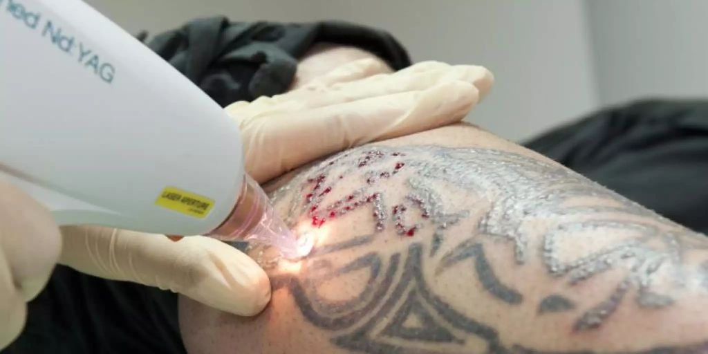 Tattoo Lasern Am Besten Beim Hautarzt