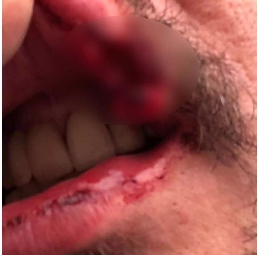 Autsch! Teewag hat einen Riss in der Lippe.