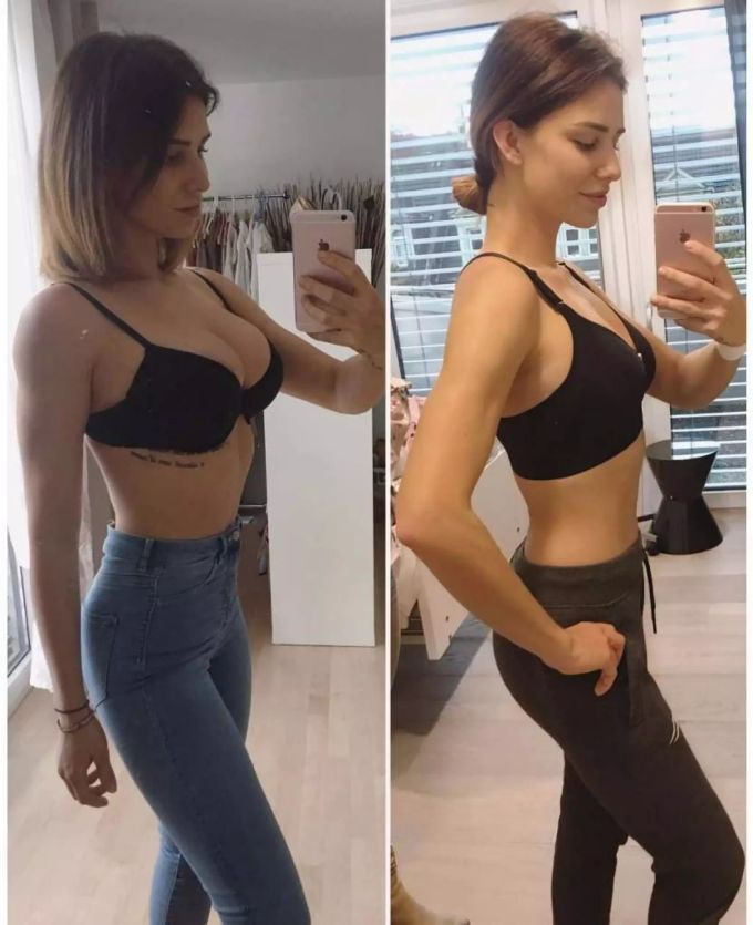 Anja Zeidler links vor der Brustverkleinerung, rechts danach: Anja liess sich je 400 Gramm Silikon entfernen. anja zeidler