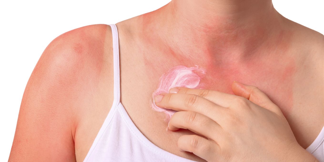 Sonnenallergie verstehen: Ursachen, Symptome und erste Hilfe