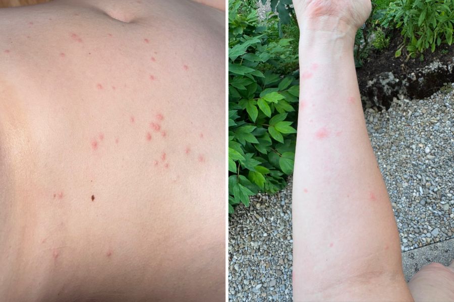Bauch und Arme sind mit «Stichen» übersät.