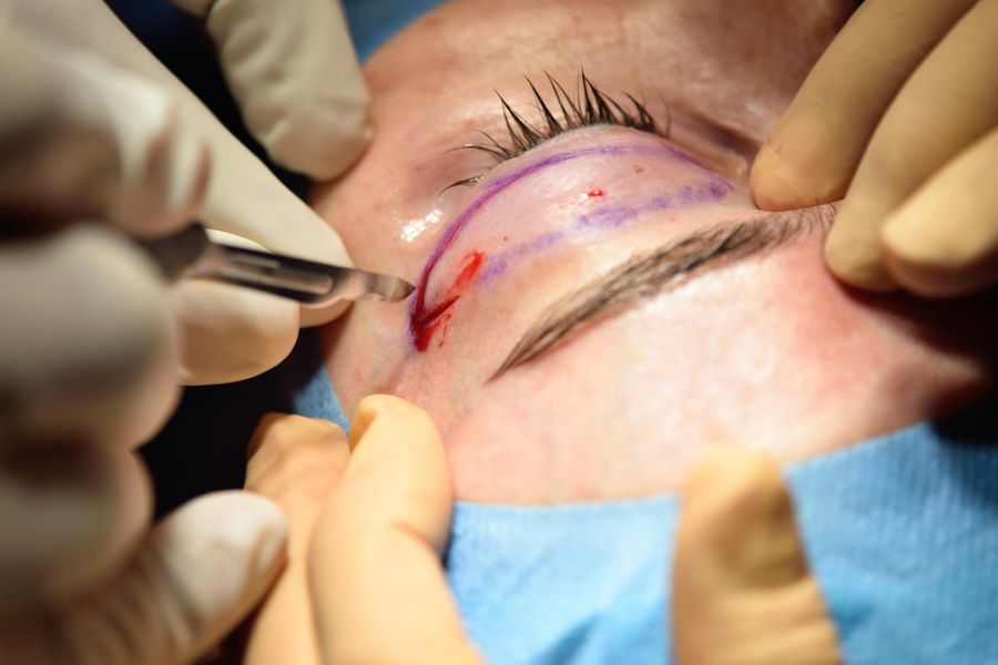 Der Eingriff ist teuer: bis zu 40'000 Franken kostet ein Deep-Plane-Facelift in der Schweiz. (Symbolbild)