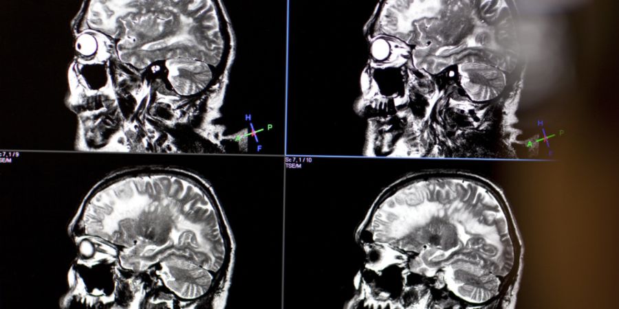 Das hinten im Kopf liegende Kleinhirn, lange vor allem für Bewegung bekannt, beeinflusst laut einer neuen Studie auch, wie stark Menschen mit Schizophrenie unter Antriebslosigkeit und ...