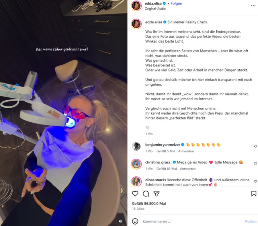 Eddas strahlendes Lächeln verdankt sie einem professionellen Bleaching.