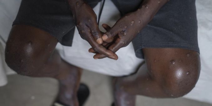 «Risiko gering» - BAG plant keine Massnahmen wegen Mpox – trotz Notlage