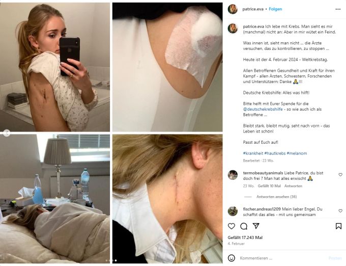 Patrice Aminati nach der Entfernung einer Metastase. krebserkrankung patrice Aminati