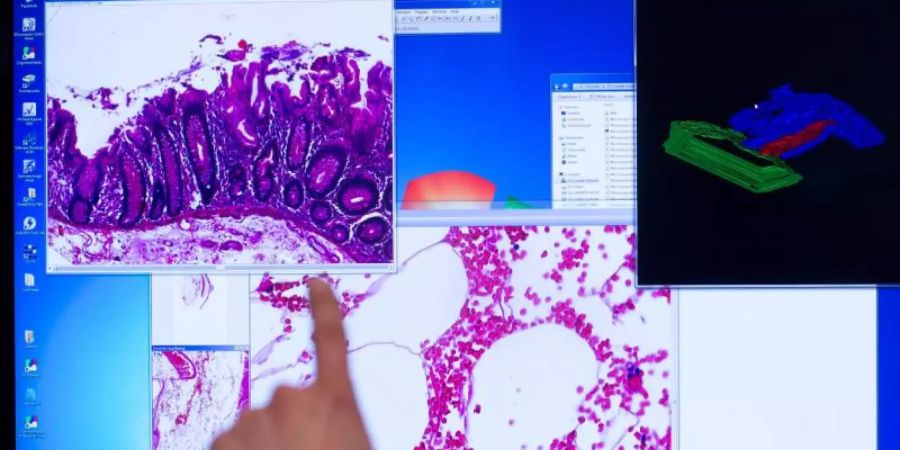 Das zu Vergrösserung eingesetzte «virtuelle Mikroskop» ermöglicht den internationalen Austausch von Befunden bei der Krebs-Diagnostik in der Pathologie. Foto: picture alliance / dpa