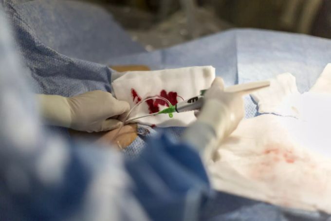 Mit einem Implantat im Gehirn könnte die Blut-Hirn-Schranke überwunden werden. aneurysma