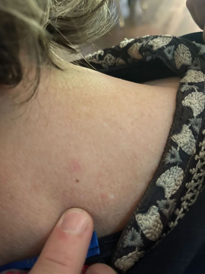 Eine Nau.ch-Leserin (Name der Redaktion bekannt) wurde vor ein paar Tagen von einer Wespe gestochen. Noch heute spürt sie den Stich. Wespenstich