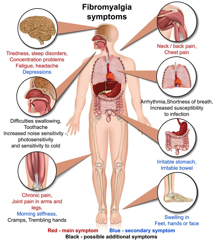 Grafik Mensch Fibromyalgie