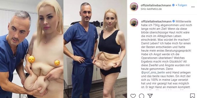 Aline Bachmann beim Beratungsgespräch vor ihrer Schönheitsoperation. 33'000 Euro wird es kosten die eüberschüssige Haut zu entfernen. ALine Bachmann DSDS