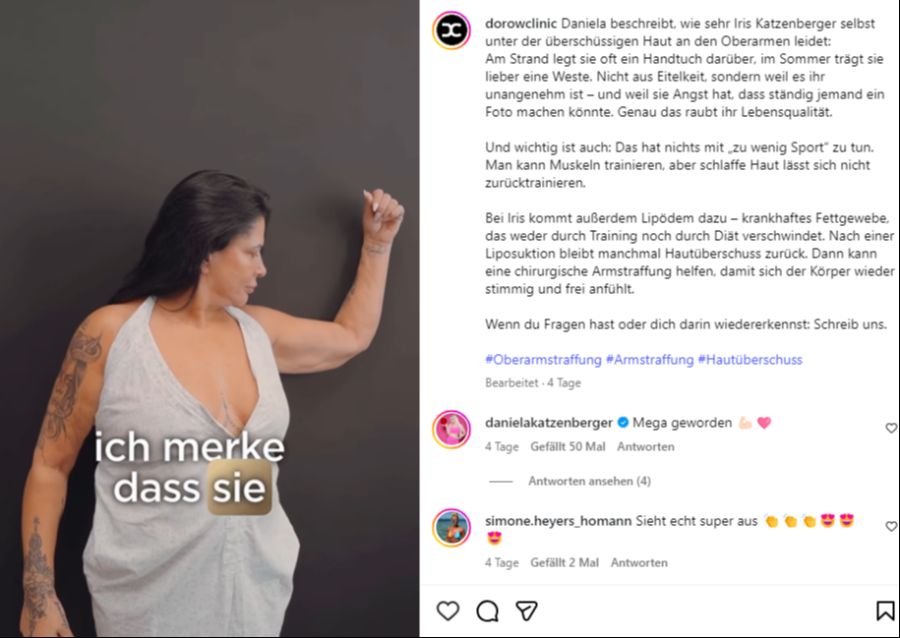 Katzenberger-Mama Iris war für eine Armstraffung beim Beauty-Doc.