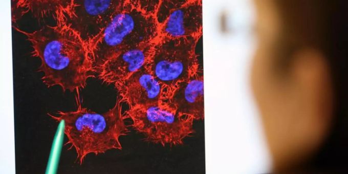 Dermatologen rechnen für die nächsten 30 Jahre mit einem deutlichen Anstieg aller Hautkrebs-Arten in Deutschland. Foto: Bernd Wüstneck Dermatologen rechnen für die nächsten 30 Jahre mit einem deutlichen Anstieg aller Hautkrebs-Arten in Deutschland. Foto: Bernd Wüstneck