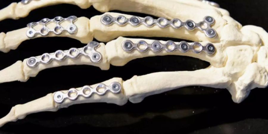 Legierungen aus Magnesium mit geringen Mengen Zink und Kalzium sind vom Körper abbaubar und eignen sich daher für Implantate wie Knochenschrauben und -platten.