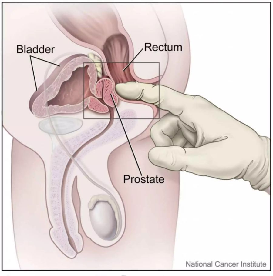 Rektale Untersuchung der Prostata.