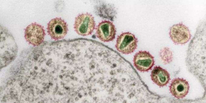 HIV-1 (Retroviren) in einer kolorierten Ultradünnschnitt-Aufnahme eines Transmissions-Elektronenmikroskops. Patient Hi Virus HIV