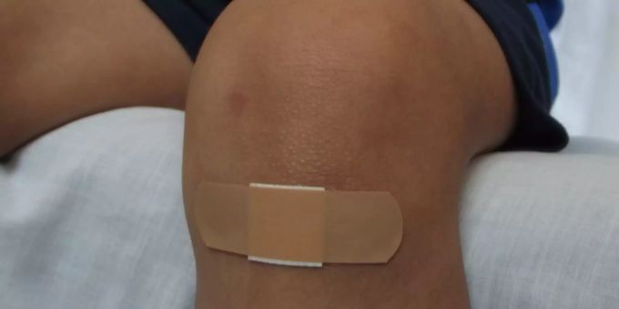Eine Wunde am Knie (Symbolbild). Wundheilung