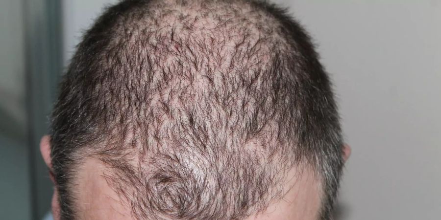 Haarausfall Therapie