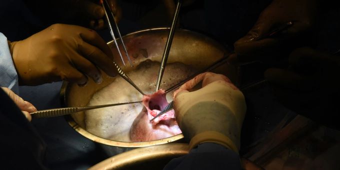 Chirurgen führen die Transplantation des Schweineherzens im Krankenhaus in Baltimore durch. Chirurgen führen die Transplantation des Schweineherzens im Krankenhaus in Baltimore durch.