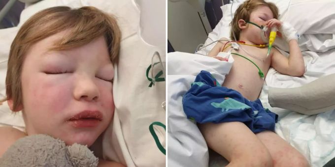 Beim sechsjährigen Briten Logan Walsh wurde sechs Wochen nach einer Corona-Infektion die Krankheit PIMS diagnostiziert. Logan Walsh Coronavirus PIMS
