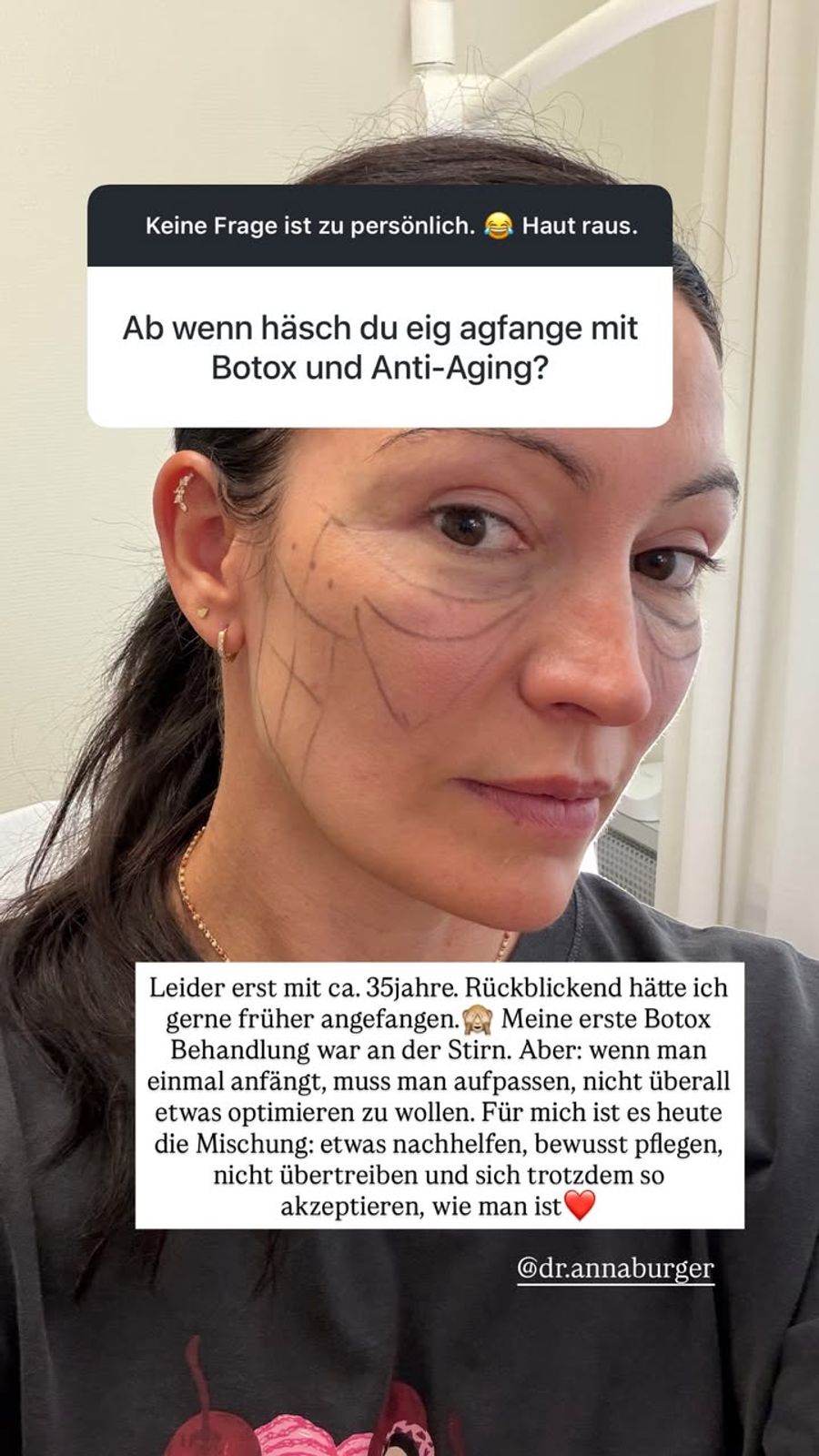 Mit Botox begann Frieda Hodel nach eigenen Angaben mit etwa 35 Jahren. Heute lässt sie ihre Zornesfalte regelmässig behandeln.