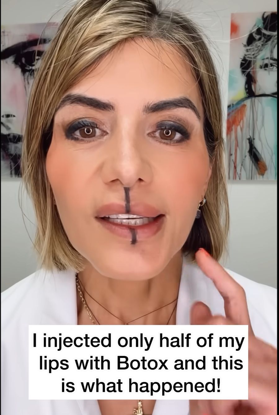 Botox in Lipp