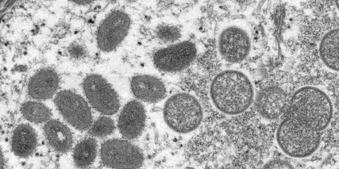 Affenpockenviren unter Mikroskop Affenpockenviren unter Mikroskop