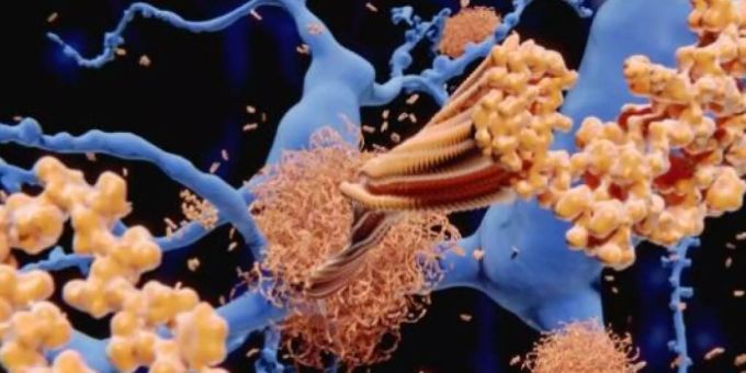 Amyloid-Beta-Plaque in den Zwischenräumen von Gehirnzellen, wie es für Alzheimer typisch ist. Amyloid-Beta-Plaque